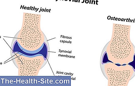 bol ispod rebara i bolovi u zglobovima injekcije hijaluronske kiseline u liječenju artroze
