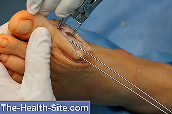 bol u zglobu kuka s hernijom liječenje u početnoj fazi artroze