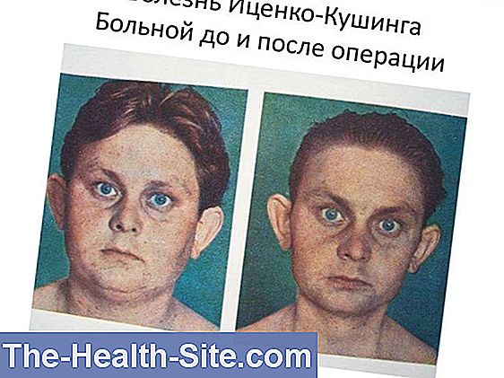 Болезнь Кушинга: Причины, Симптомы, Терапия 💊 Научно-практический ...